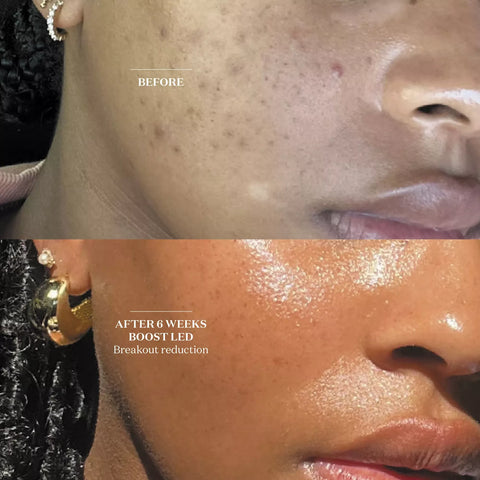 Light Salon Boost Advanced LED Mask