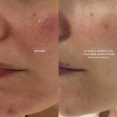 Light Salon Boost Advanced LED Mask