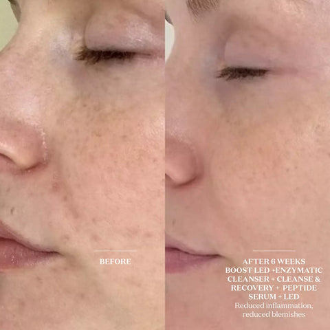 Light Salon Boost Advanced LED Mask