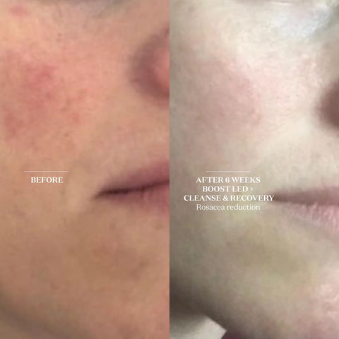 Light Salon Boost Advanced LED Mask